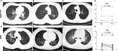 Exhausting T Cells During HIV Infection May Improve the Prognosis of Patients with COVID-19